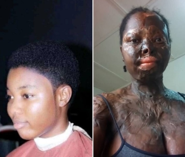 Martha Acid Attack